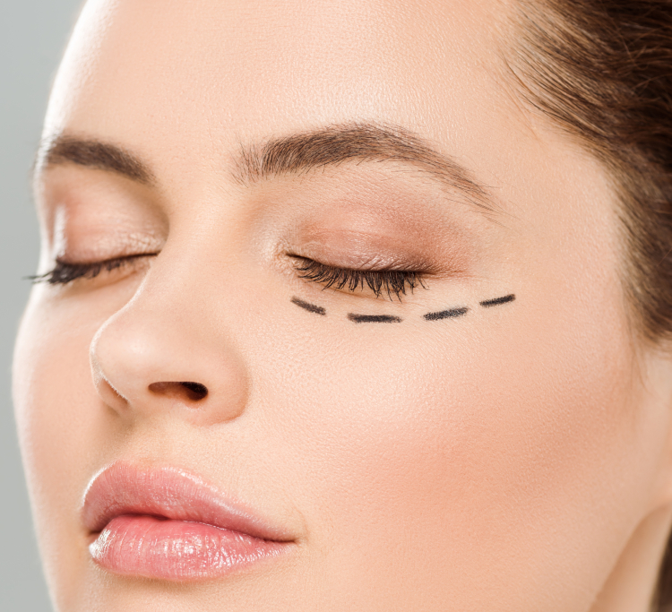 Blepharoplasty before and after illustration