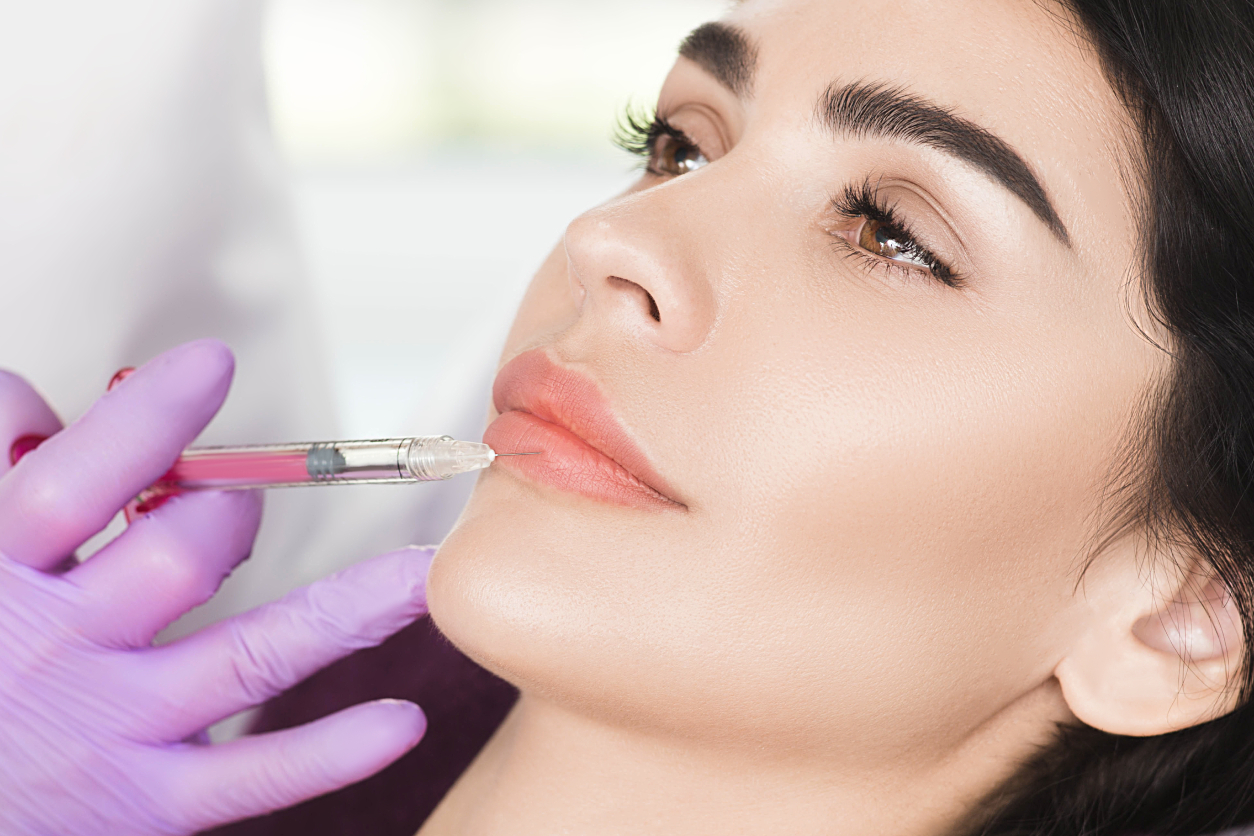 Lip lift surgical illustration